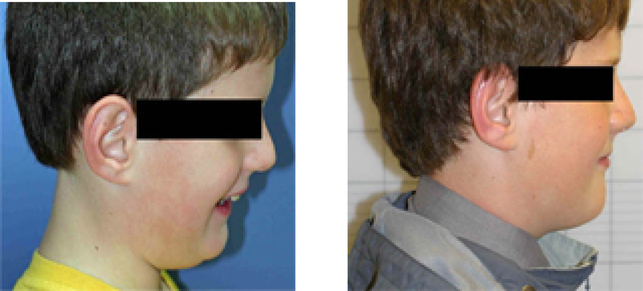 Facial profile change with appliances - child.jpg